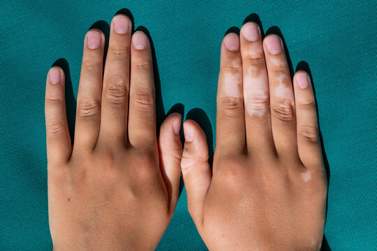 Close-up of hands with vitiligo on a textured teal background