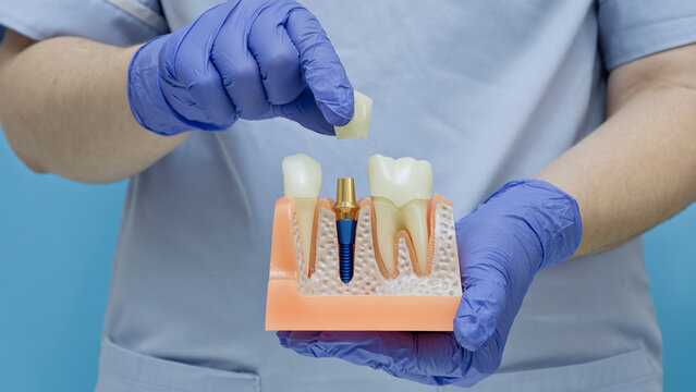 Dentist hands in blue gloves placing a ceramic crown on a dental implant abutment using a jaw anatomical model.