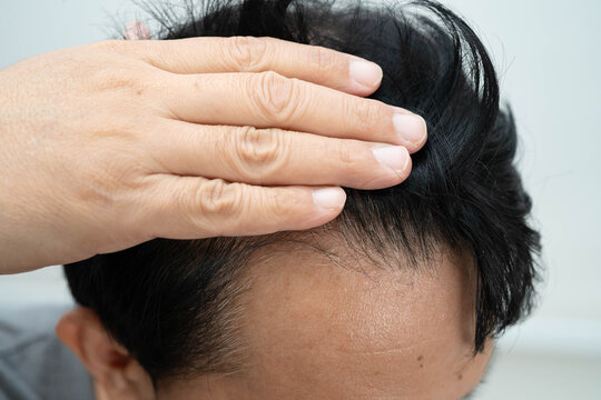Bald in the middle head and begin no loss hair glabrous of mature man.