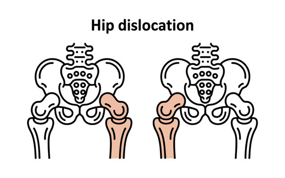 Anatomical illustration of a hip dislocation showing the pelvis and femur