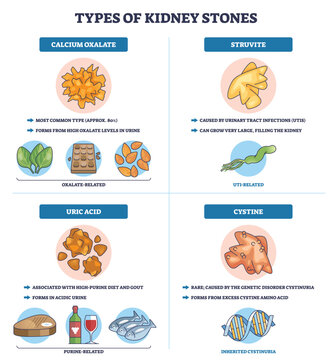 Kidney stones types chart showing calcium oxalate, uric acid, struvite, and cystine, icons of stones, labels, and arrows explain causes and diet links. Outline diagram