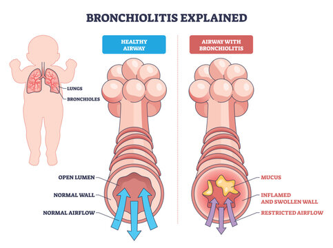 Bronchiolitis explained contrasts healthy and inflamed airways, highlighting lungs, bronchioles, and mucus blockage to show restricted airflow in infants. Outline diagram