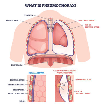 Pneumothorax overview shows air in pleural space collapsing one lung, key objects, lung, pleural space, ruptured bleb. Outline diagram