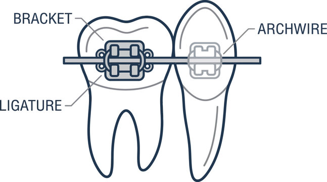 Orthodontic braces ligature archwire medical line art vector illustration