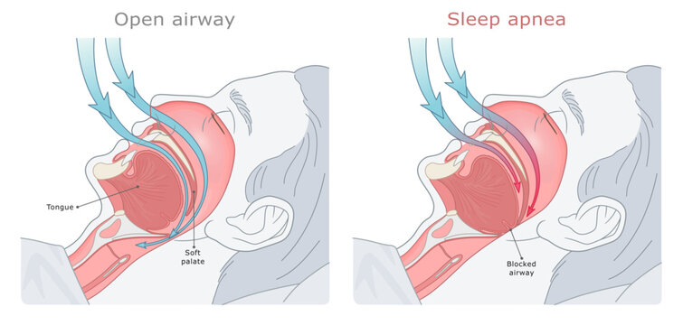 Medical illustration of obstructive sleep apnea, showing the tongue blocking the airway in the throat. ENT Series.