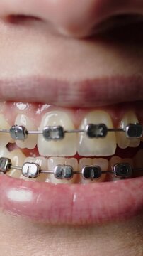 Vertical video: Zooming in, mouth parting and closing subtly in close-up, showing metal brackets