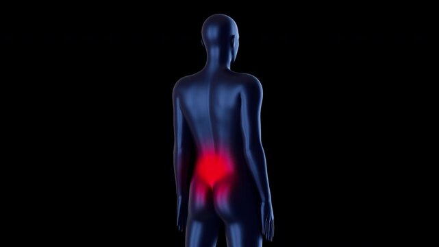 3D medical animation of human silhouette with glowing red inflammation in lumbar region. Represents lower back pain, sciatica or disc herniation.