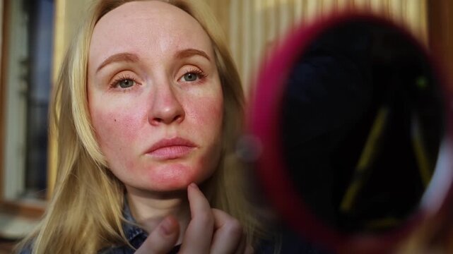 Rosacea and couperosis of the skin. The girl suffers from redness on her cheeks or sunburn symptoms. Redness and capillary mesh are visible on the face. Vascular surgery and dermatology
