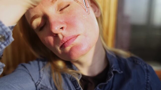 Rosacea and couperosis of the skin. The girl suffers from redness on her cheeks or sunburn symptoms. Redness and capillary mesh are visible on the face. Vascular surgery and dermatology