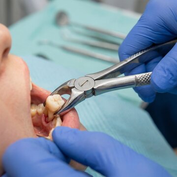 Dentist extracting a molar tooth from a patient mouth using surgical forceps in a dental clinic.