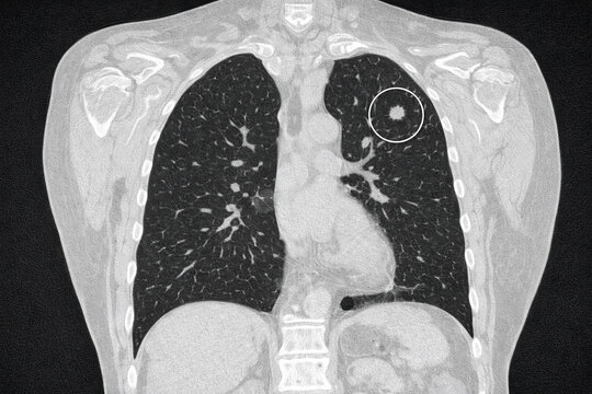Photorealistic clinical scene: patient undergoing low-dose CT lung screening in a modern CT suite, patient on CT table, radiographer nearby