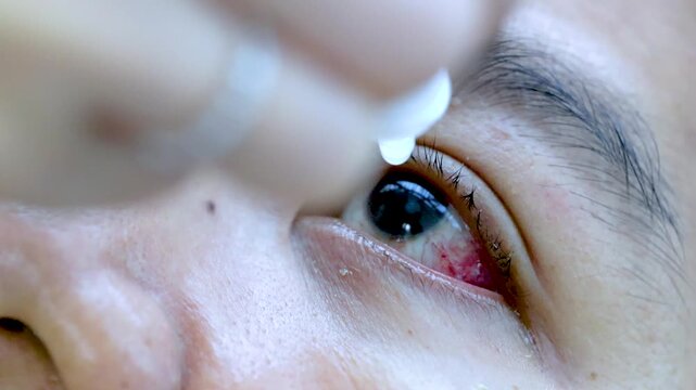 Close-up of applying eye drops to a red inflamed eye for medical treatment.