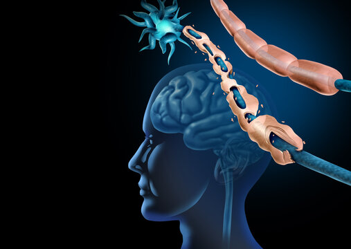 Multiple Sclerosis MS neurological disease concept showing demyelination and nerve damage in the brain and central nervous system as a medical illustration of autoimmune disorder as cognitive function