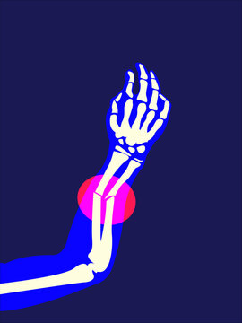 	
X-ray result showing a fracture injury in the arm. 2D Picture rontgen of arm bone in painful injury damage. Vector illustration.