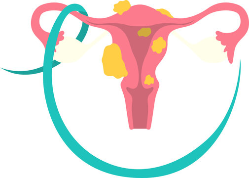 Uterine Fibroids Medical Illustration
