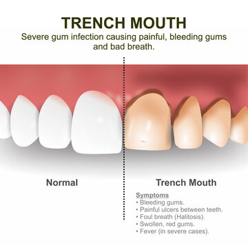 Trench Mouth Teeth Infographic flashcard