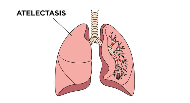 Anatomical diagram of human lungs highlighting the condition of atelectasis with text labels on a white background.