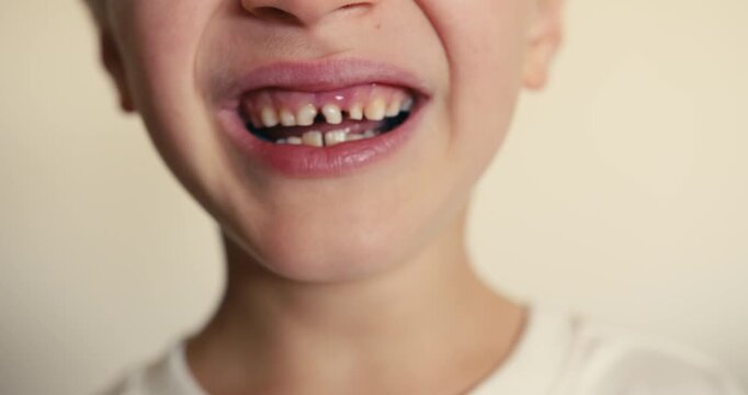 Close-up of a child smile with baby teeth showing plaque and cavities. The child wiggles a loose front baby tooth. Children dental hygiene. Dental care.