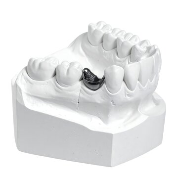 A dental model with a metal dental implant