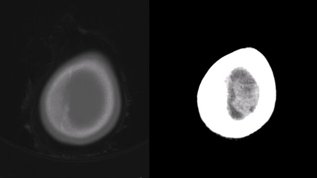 Axial CT scan slices of a human head demonstrating severe hydrocephalus, cerebral atrophy, and a ventricular shunt catheter placement in the brain.