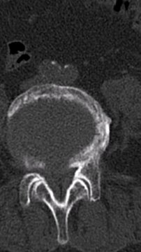 Axial CT Showing L5 Vertebral Fracture