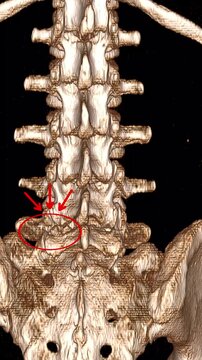 A detailed 3D computed tomography scan showing a fracture in the pars interarticularis of the lower spine, illustrating a common cause of lower back pain and vertebral instability.