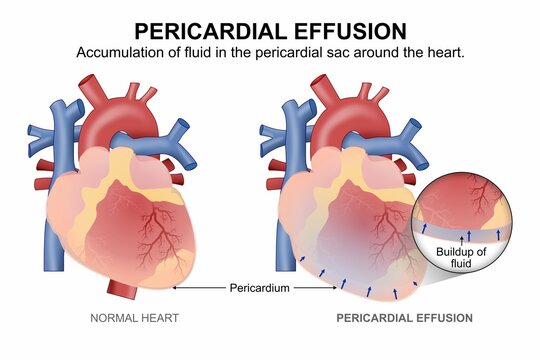 Pericardial effusion fluid filled heart illustration