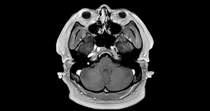 High-contrast grayscale Magnetic Resonance Imaging (MRI) in axial view. Clearly visualizes the intricate vascular network of the human brain.
