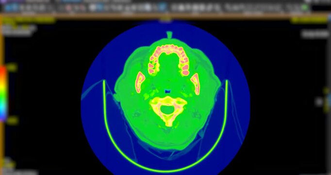 Animated coronal Computed Tomography Angiography (CTA) scan of a human head. Features vibrant green thermal color mapping for medical or scientific visuals.
