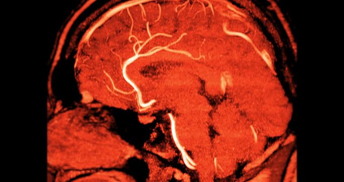 Magnetic Resonance Angiography (MRA) of the human brain shown in multiplanar grayscale views. Displays normal cerebral blood vessels for clinical diagnosis.