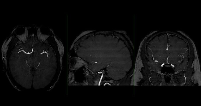 Magnetic Resonance Angiography (MRA) of the human brain shown in multiplanar grayscale views. Displays normal cerebral blood vessels for clinical diagnosis.