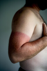 Fototapeta premium Severe sunburn on male arm with clear tan line. Close-up of irritated red skin after sun exposure, highlighting damage, pain and need for sun protection.