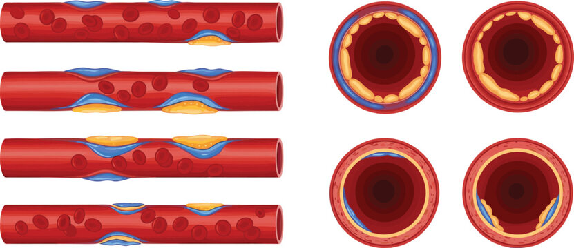 Artery Blockage Progression Illustration with Cholesterol Plaque Buildup and Blood Flow Restriction Cross Section Cardiovascular Disease Medical Vector Diagram Set