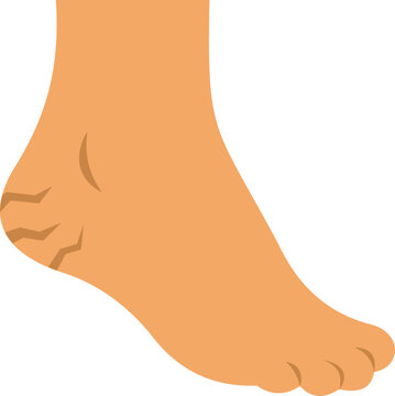 Illustration of a human foot showing dry cracked heel representing skin care and health issues