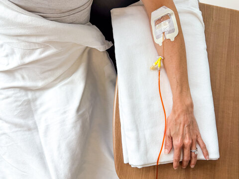 Overhead View of Woman's Arm with IV Iron Infusion
