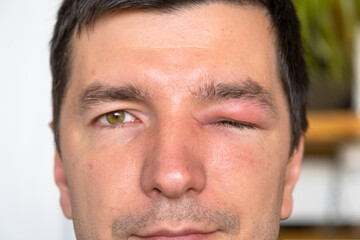 Obraz premium Swollen eyelid after insect (bee) sting, allergy, severe redness, pain and risk of serious effects, possible causes include trauma, conjunctivitis, infection.
