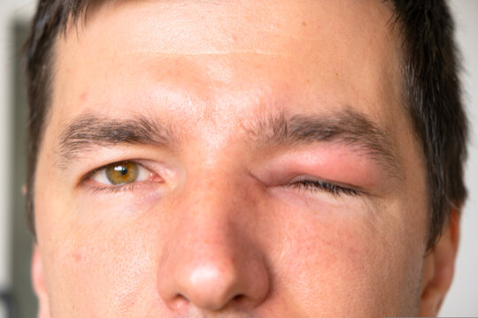 Unilateral eyelid swelling after bee sting, allergic reaction, pain, redness, risk factors: infection, injury, foreign body, conjunctivitis, abscess, urgent care.