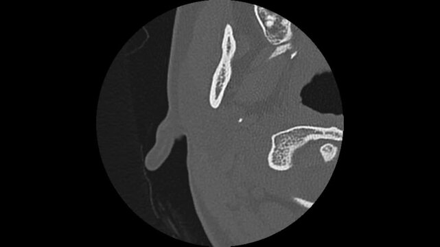 High-resolution HRCT scan of the human temporal bone providing a detailed radiological view of the middle and inner ear structures.