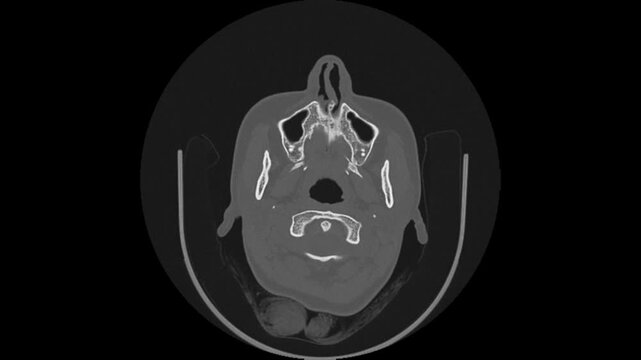 Professional medical imaging showing a transverse section of the cranium focusing on the auditory canal and mastoid for clinical diagnosis.