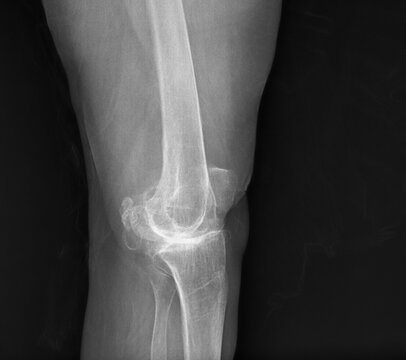 Clear digital scan of an adult knee joint displaying the femoral condyles and tibial plateau for medical evaluation. An ideal grayscale asset for healthcare education, radiology studies, 