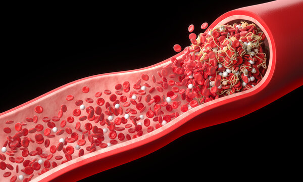 3D illustration of a blood clot formation with red blood cells trapped in a fibrin mesh inside a blood vessel.