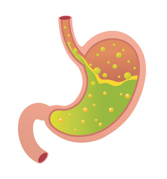 Gastroesophageal or gerd Reflux Disease. Stomach acid flowing up into the esophagus due to an open sphincter