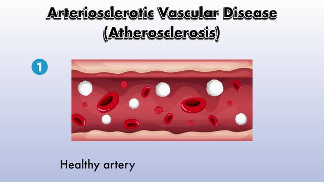 Arteriosclerotic vascular disease atherosclerosis progression shown in artery cross-section.