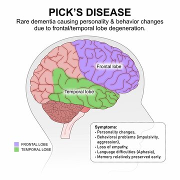 Pick&rsquo;s disease brain flashcard illustration