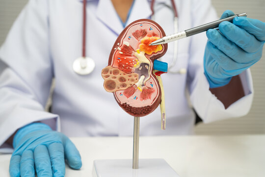 Chronic kidney disease, doctor with model for treatment urinary system, urology, Estimated glomerular filtration rate eGFR.