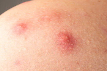 Fototapeta premium Macro shot of skin irritation with acne. Inflamed skin bumps acne macro. Skin problem background with infected bumps and acne. Detailed skin with acne.