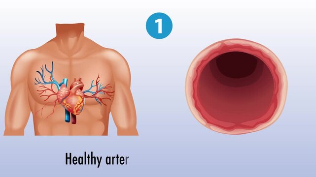 Arteriosclerotic vascular disease atherosclerosis stages motion graphic with detailed medical explanation.