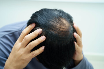 Fototapeta premium Bald head in man, hair loss treatment health problem.