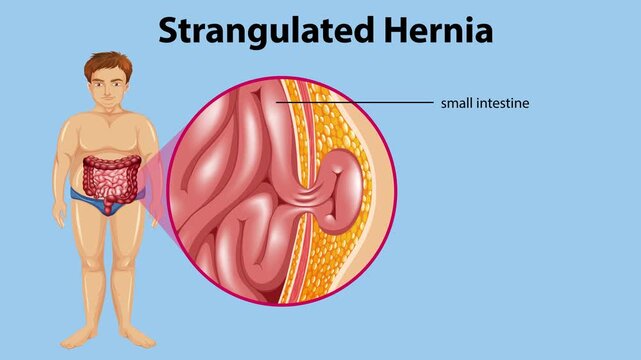 Medical animation showing a person with a painful strangulated hernia condition, highlighting abdominal wall and intestinal protrusion.