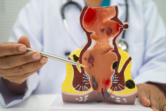 Asian doctor with rectum and hemorrhoid human anatomy model at hospital, inflamed vascular structure.